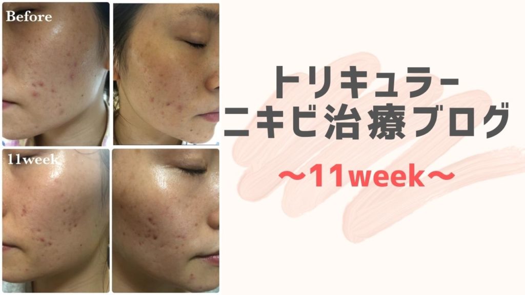 原因不明ニキビ 低用量ピル トリキュラー ブログ 11週間目 しこりニキビ ニキビ跡との戦い パンダ県に住むa子さん